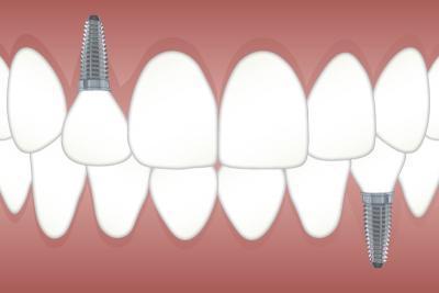 nettoyage implant dentaire lyon 7